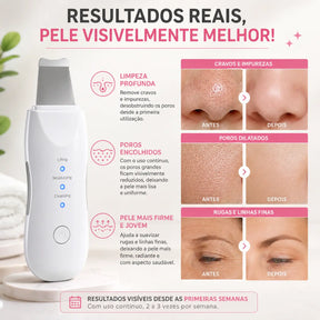 Aparelho Peeling Ultrassônico
