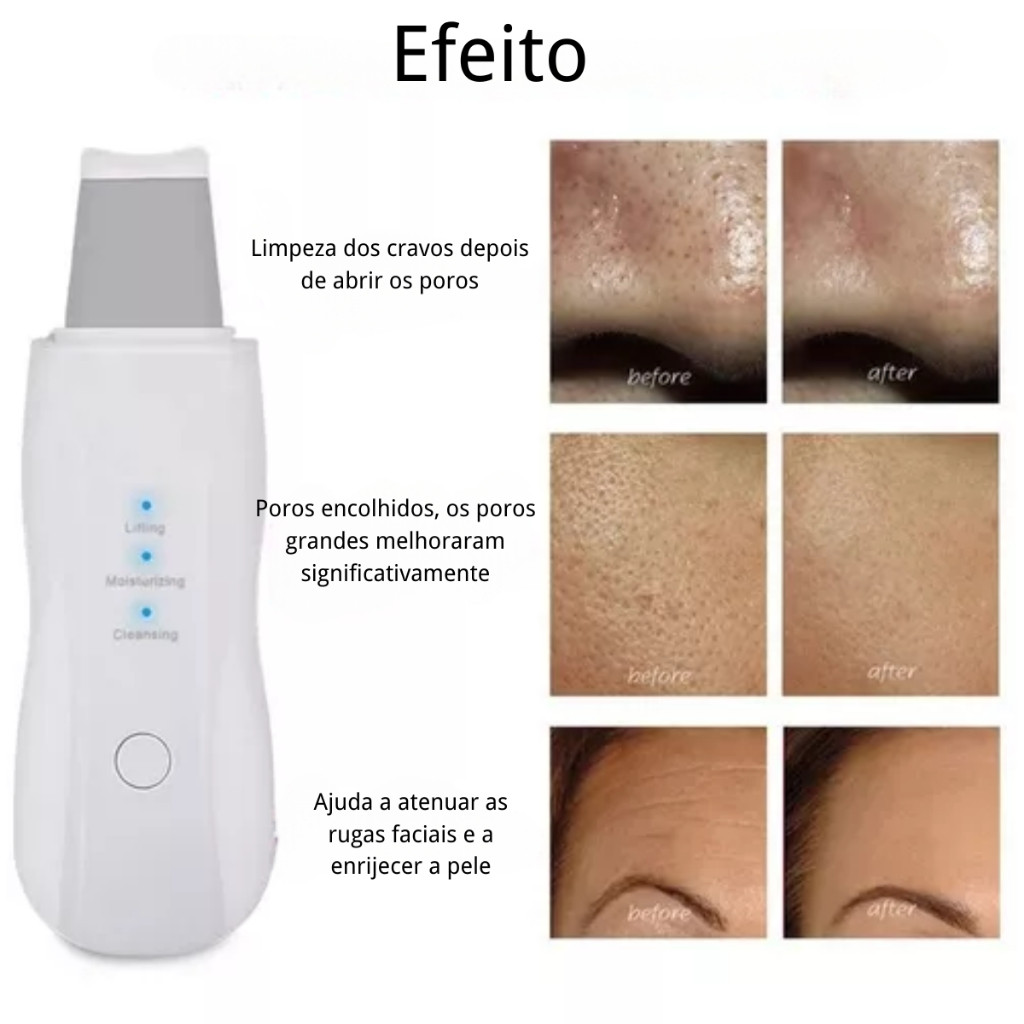 Aparelho Peeling Ultrassônico | Limpeza Facial Profunda + Remoção de Cravos