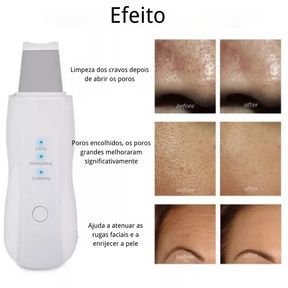 Aparelho Peeling Ultrassônico | Limpeza Facial Profunda + Remoção de Cravos